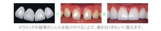 セラミックの極薄のジェルを貼り付けることで、歯を白くきれいに整えます