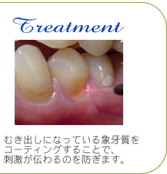 むき出しになっている象牙質をレーザーでコーティングすることで刺激が伝わるのを防ぎます。