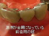 前歯の冠