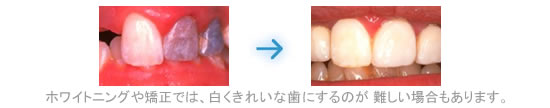 ホワイトニングや矯正では、白くきれいな歯にするのが難しい場合もあります