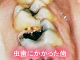 虫歯にかかった歯